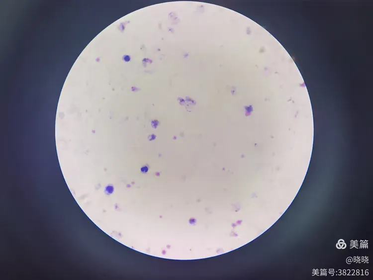 三种疟原虫厚膜染色法对比